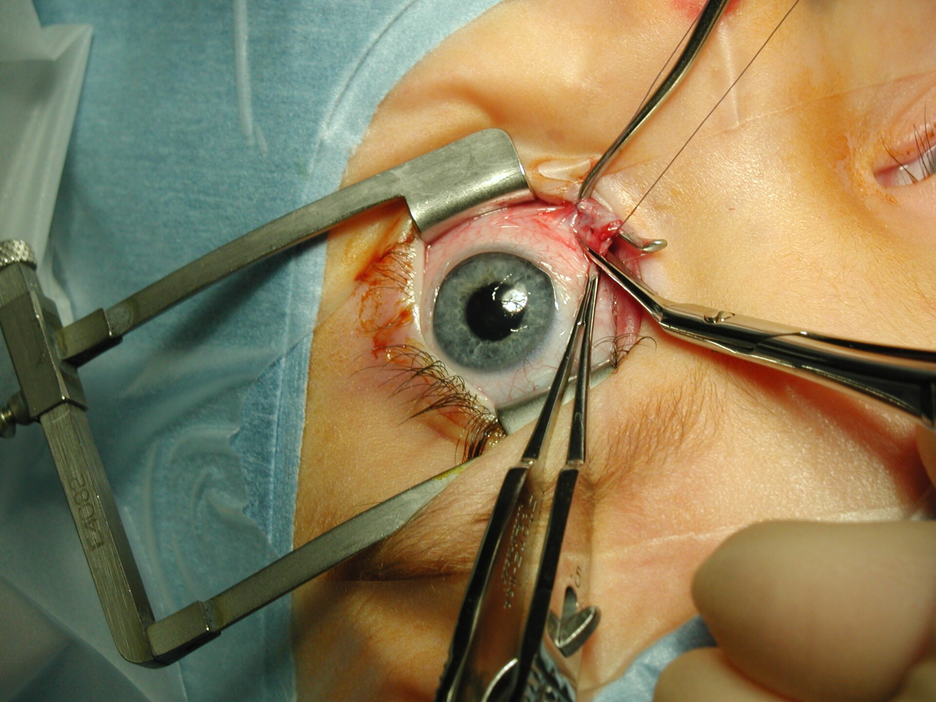 Imagem de referência relacionada a Cirurgia corretora do estrabismo, item descrito como registro de referência sobre Cirurgia corretora do estrabismo, organizado a partir de dados estruturados abertos